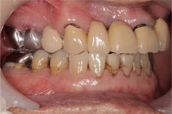 インプラント All On 4による全顎的な治療 神戸市垂水区の歯医者スター歯科クリニック